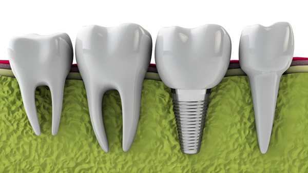 Dental Implants Help In Gum Disease